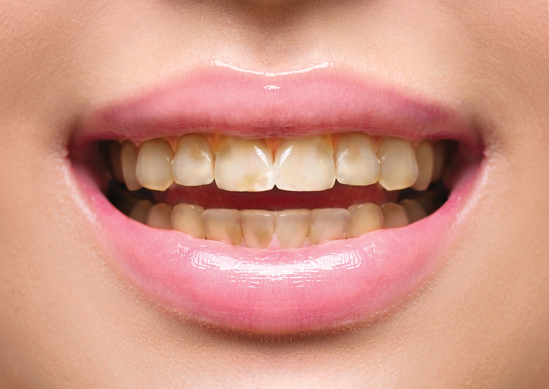 Teeth Whitening | Dr. Patty Cosmetic Dentistry | Miami, FL