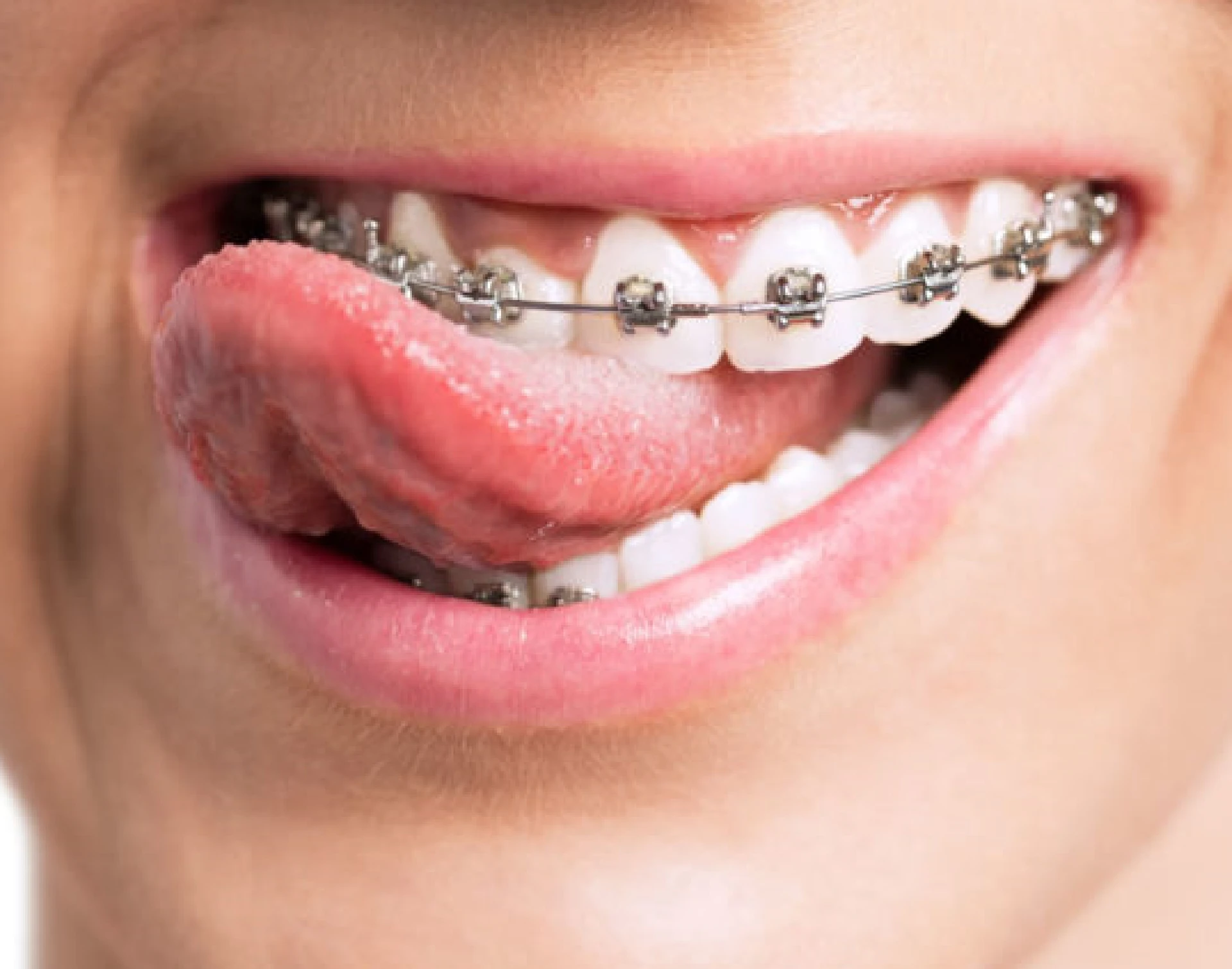 Premium Dental Crowns in Miami, FL | Dr. Patty Miami Cosmetic Dentistry - Call 305-735-3002